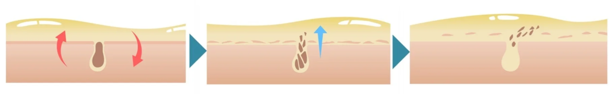 Limpieza profunda de poros