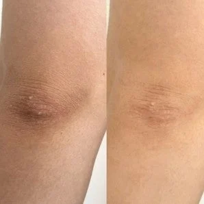 Comparaci&oacute;n de rodillas antes y despu&eacute;s del tratamiento