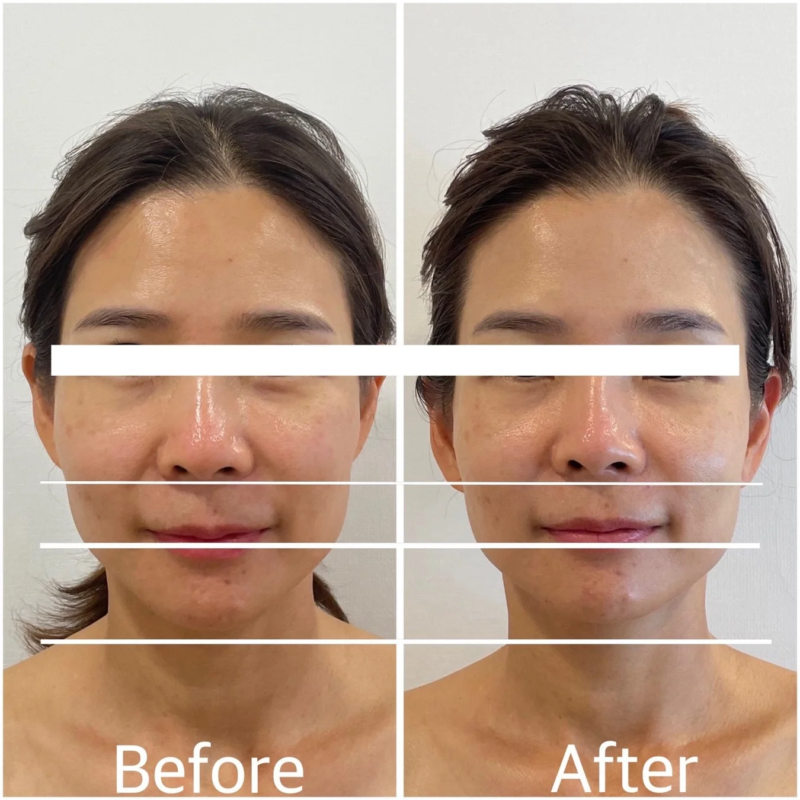 Antes y despu&eacute;s del tratamiento de acortamiento facial