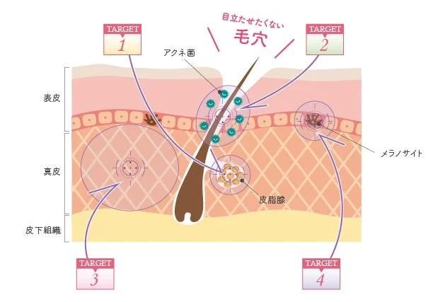 Mecanismo de mejora de poros de iVC&reg; MGA