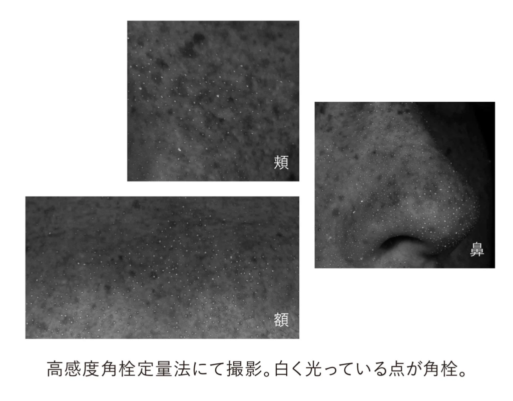 Puntos negros en la piel