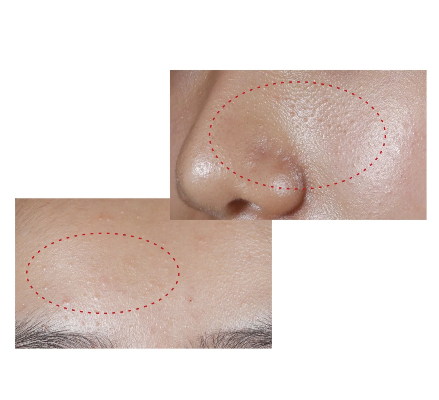 Piel con "monta&ntilde;as de poros"