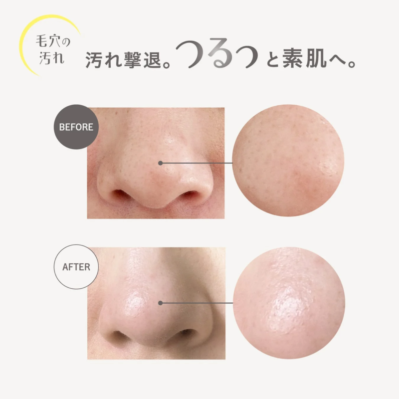 Antes y despu&eacute;s de la limpieza de poros con CP Serum Cleansing Oil V